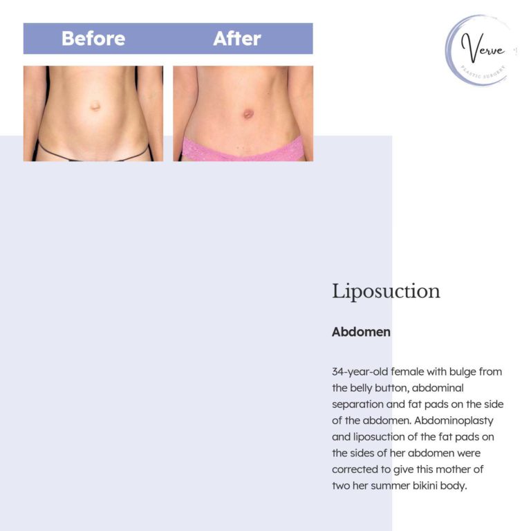 Before and After images of Liposuction, Abdomen - 34 year old female with bulge from the belly button, abdominal separation and fat pads on the side of the abdomen. Abdominoplasty and liposuction of the fat pads on the sides of her abodmen were corrected to give this mother of two ther summer bikini body.