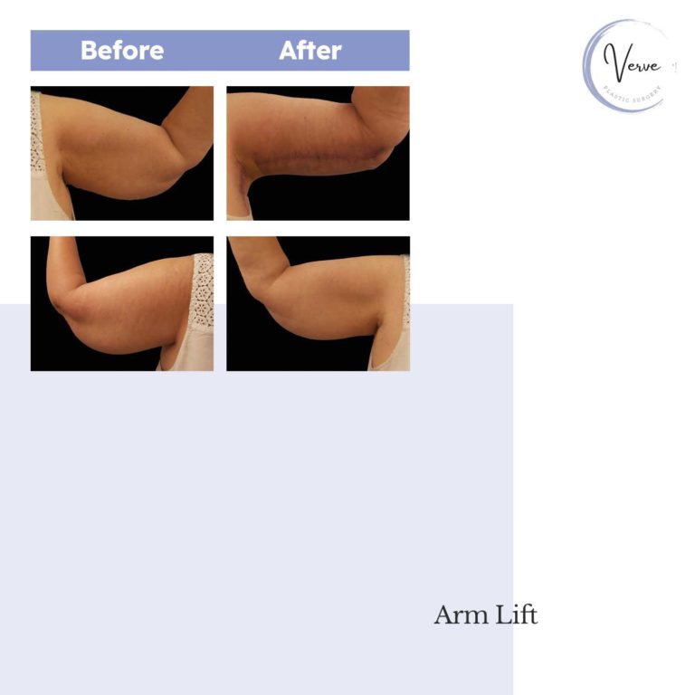 Before and After images of Arm Lift