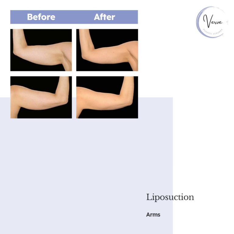 Before and After images of Liposuction, Arms