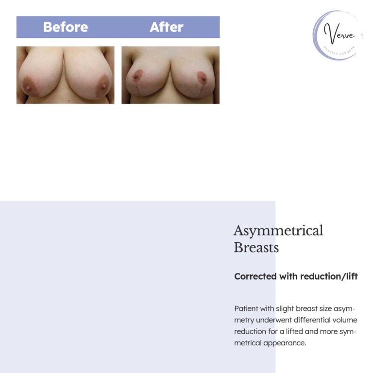 before and after images of asymmetrical breasts, corrected with reduction/lift