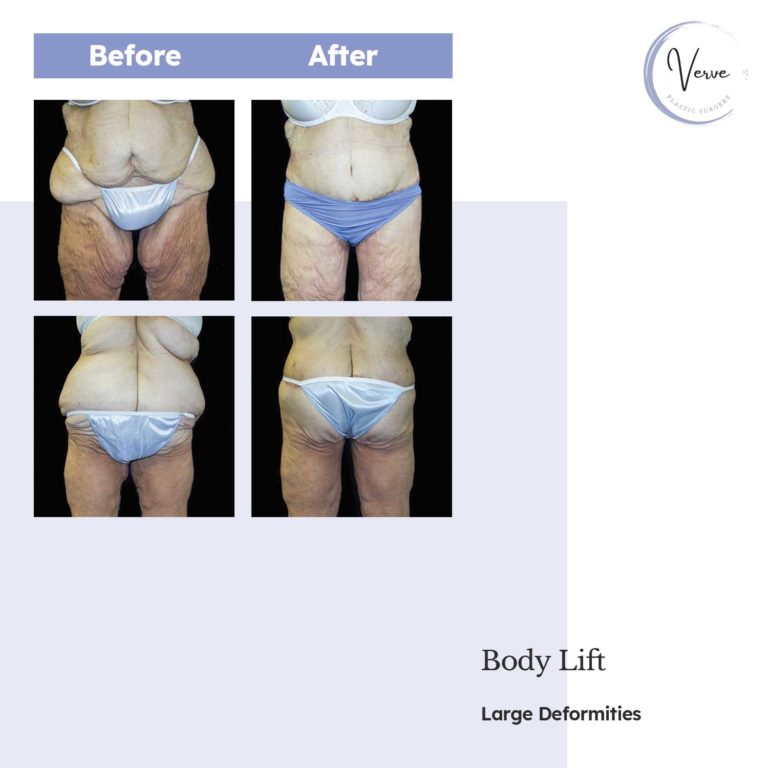 before and after images of body lift, large deformities