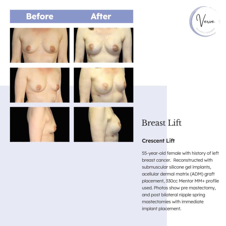 Before and After images of Breast Lift, Crescent Lift - 55-year-old female with history of left breast cancer. Reconstructed with submuscular silicone gel implants, acellular dermal matrix (ADM) graft placement, 330cc Mentor MM+ profile used. Photos show pre mastectomy, and post bilateral nipple spring mastectomies with immediate implant placement.