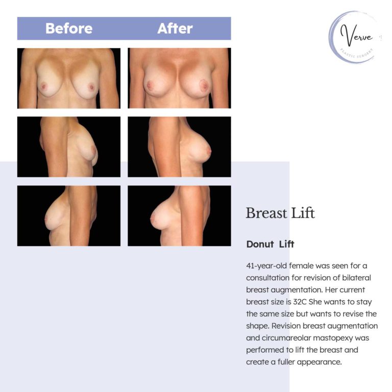 Before and After images of Breast Lift, Donut Lift - 41-year-old female was seen for a consultation for revision of bilateral breast augmentation. Her current breast size is 32C She wants to stay the same size but wants to revise the shape. Revision breast augmentation and circumareolar mastopexy was performed to lift the breast and create a fuller appearance.