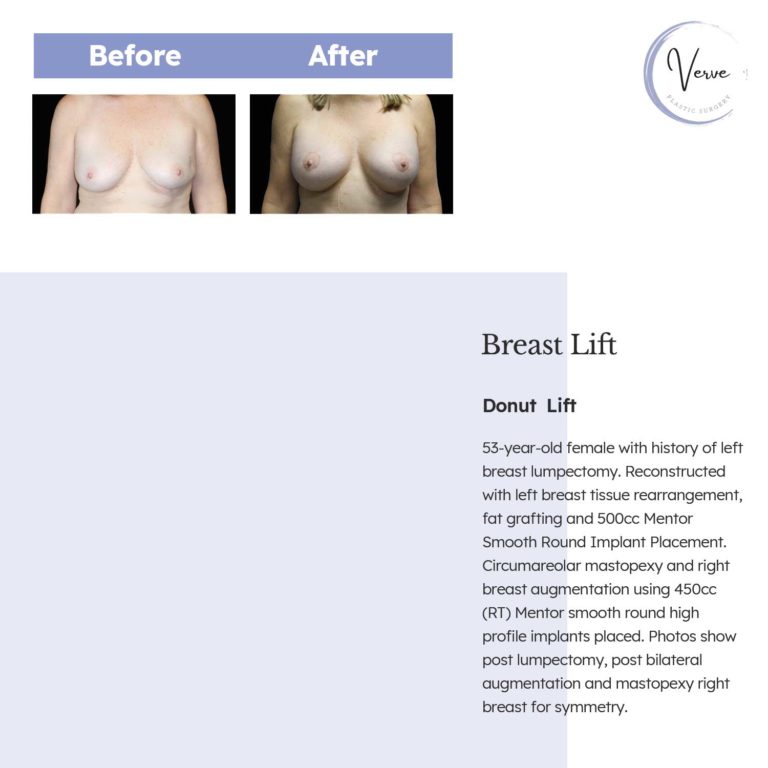 Before and After images of Breast Lift, Donut Lift - 53-year-old female with history of left breast lumpectomy. Reconstructed with left breast tissue rearrangement, fat grafting and 500cc Mentor Smooth Round Implant Placement. Circumareolar mastopexy and right breast augmentation using 450cc (RT) Mentor smooth round high profile implants placed. Photos show post lumpectomy, post bilateral augmentation and mastopexy right breast for symmetry.