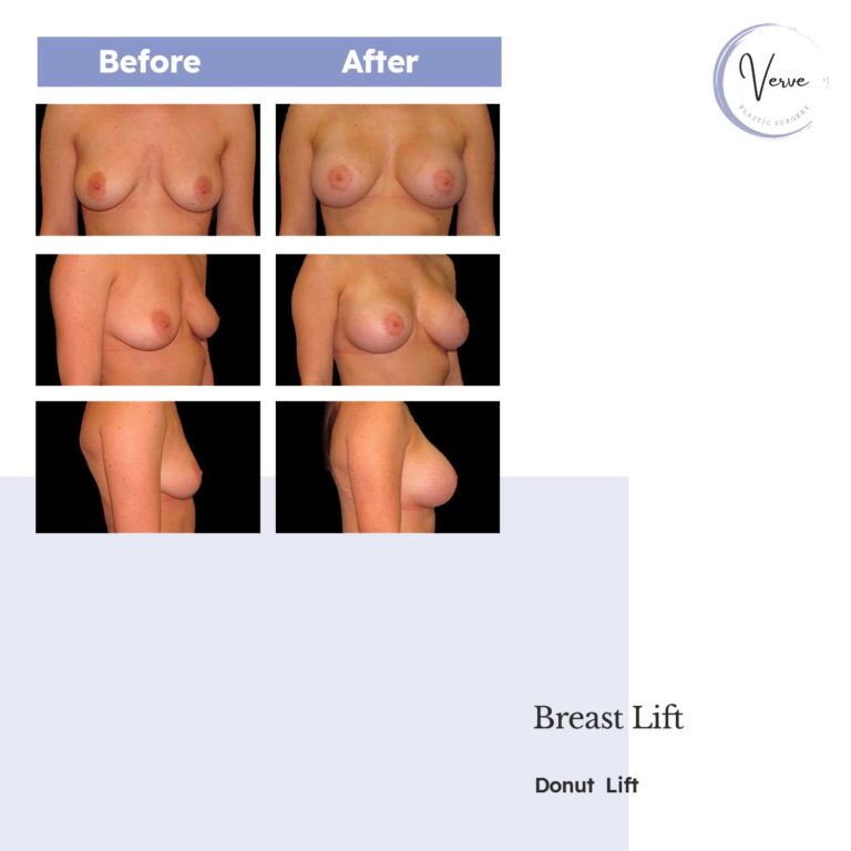 Before and After images of Breast Lift - Donut Lift