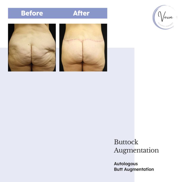 Before and After images of Buttock Augmentation, Autologous Butt Augmentation