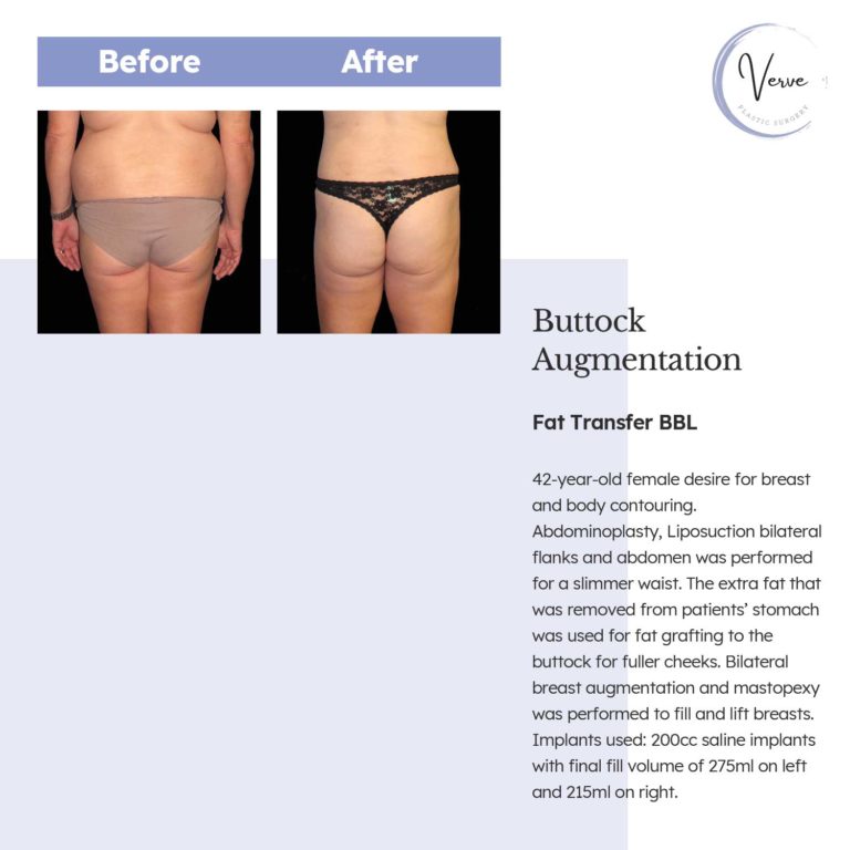 Before and After images of Buttock Augmentation, Fat Transfer BBL - 42 year old female desire for breast and body contouring. Abdominoplasty, liposuction bilateral flanks and abdomen was performed for a slimmar waist. The extra fat that was removed from patients' stomach was used for fat grafting to the buttock for fuller cheeks. Bilateral breast augmentation and mastopexy was performed to fill and lift breasts. Implants used: 200cc saline implants with final fill volume of 275ml on left and 215ml on right.