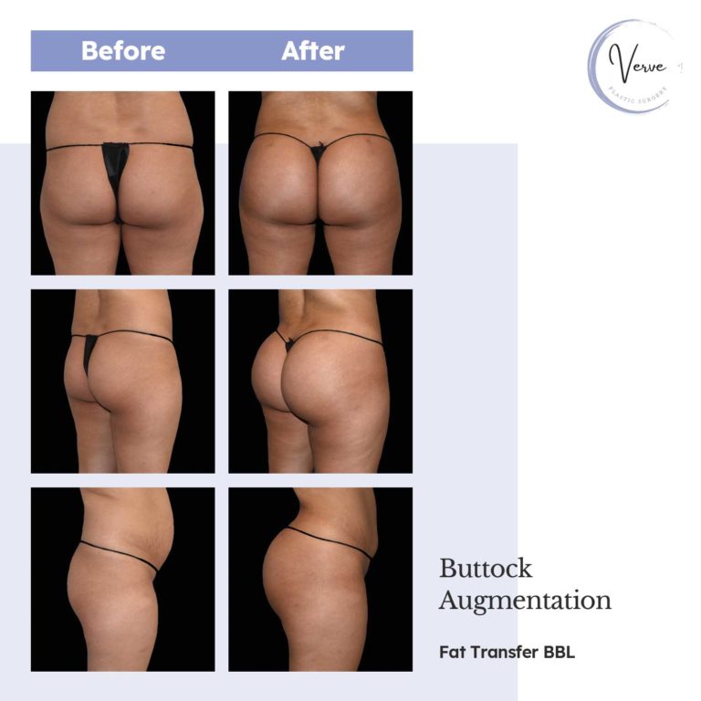 Before and After images of Buttock Augmentation, Fat Transfer BBL