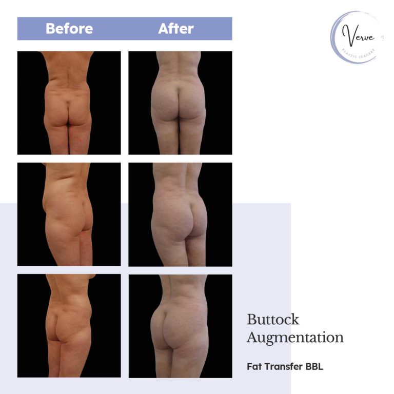 Before and After images of Buttock Augmentation, Fat Transfer BBL