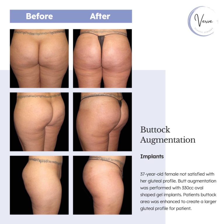 Before and After images of Buttock Augmentation, Implants - 37 year old female not satisfied with her gluteal profile. Butt augmentation was performed with 330cc oval shaped gel implants. Patients buttock area was enhanced to create a larger gluteal profile for patient.