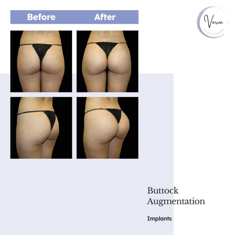Before and After images of Buttock Augmentation, Implants