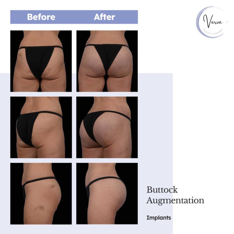 Before and After images of Buttock Augmentation, Implants