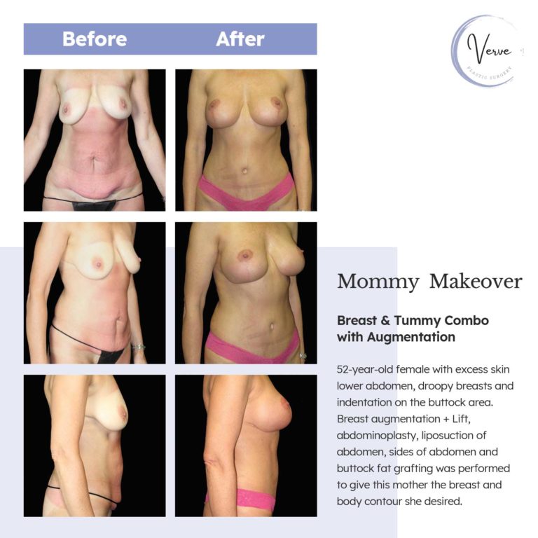 Before and After images of Mommy Makeover, Breast & Tummy Combo with Augmentation - 52 year old female with excess skin lower abdomen, droopy breasts and indentation on the buttock area. Breast augmentation + lift, abdominoplasty, liposuction of abdomen, sides of abdomen and buttock fat grating was performed to give this mother the breast and body countour she desired.