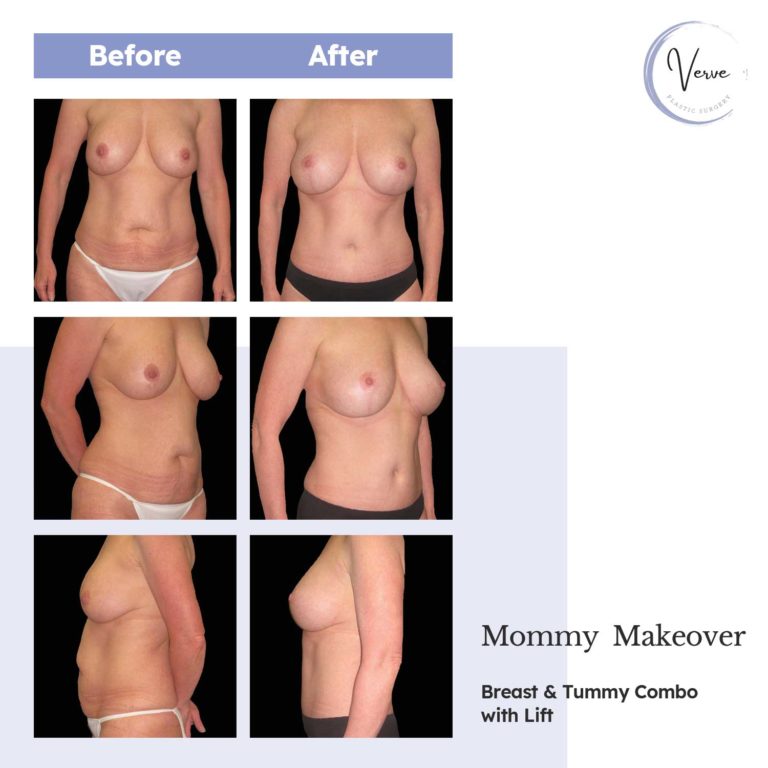 Before and After images of Mommy Makeover, Breast & Tummy Combo with Lift