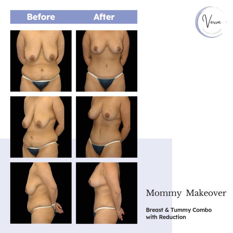 Before and After images of Mommy Makeover, Breast & Tummy Combo with Reduction