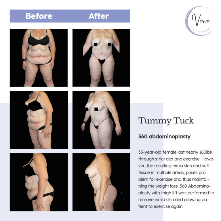 before and after images of tummy tuck, 360 abdominoplasty
