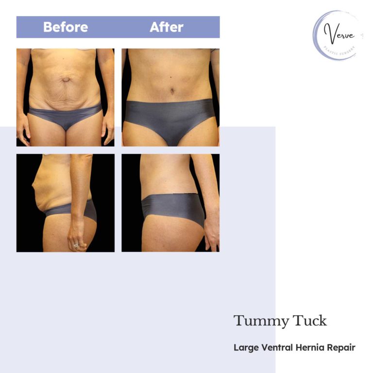 before and after images of tummy tuck, large ventral hernia repair