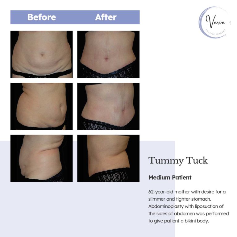 before and after images of tummy tuck, medium patient