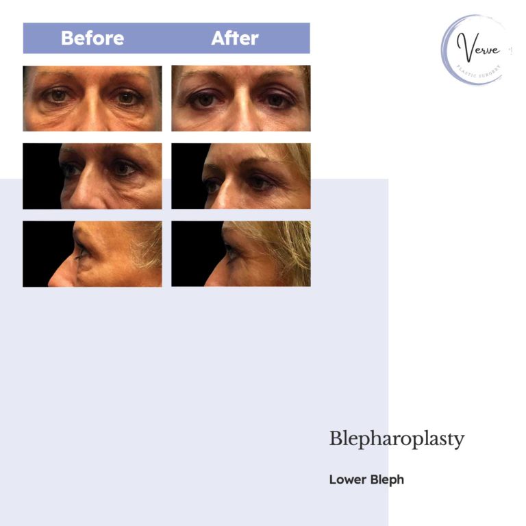Before and After images of Blepharoplasty, Lower Bleph