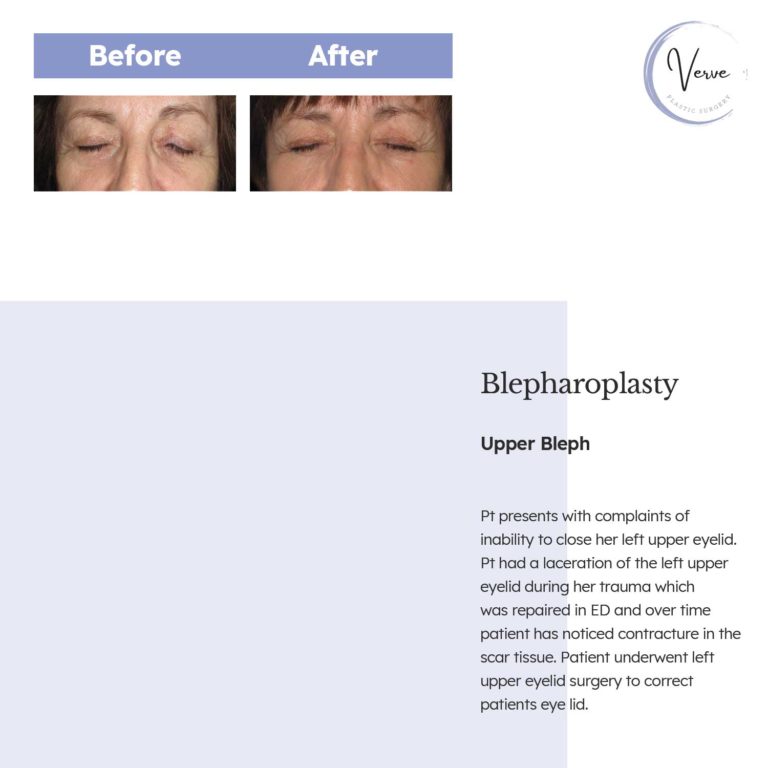 Before and After images of Blepharoplasty, Upper Bleph - Patient presents with complaints of inability to close her left upper eyelid. Patient had a laceration of the left upper eyelid during her trauma which was repaired in ED and over time patient has noticed contracture in the scar tissue. Patient underwent left upper eyelid surgery to correct patients eye lid.