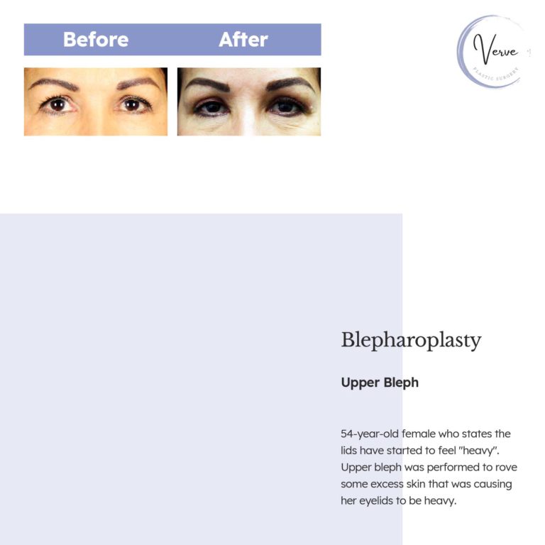 Before and After images of Blepharoplasty, Upper Bleph - 54 year old female who states the lids have started to feel "heavy". Upper bleph was performed to rove some excess skin that was causing her eyelids to be heavy.