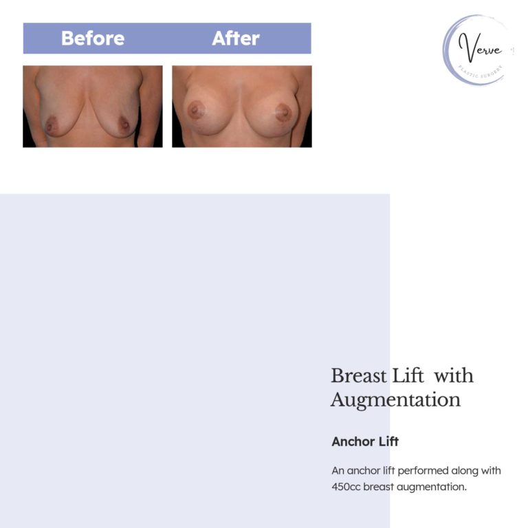 Before and After images of Breast Lift with Augmentation, Anchor Lift - An anchor lift performed along with 450cc breast augmentation.