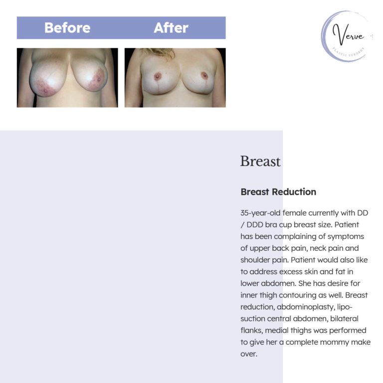Before and After images of Breast, Breast Reduction - 35-year-old female currently with DD / DDD bra cup breast size. Patient has been complaining of symptoms of upper back pain, neck pain and shoulder pain. Patient would also like to address excess skin and fat in lower abdomen. She has desire for inner thigh contouring as well. Breast reduction, abdominoplasty, lipo- suction central abdomen, bilateral flanks, medial thighs was performed to give her a complete mommy make over.