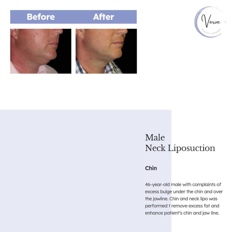 Before and After images of Male Neck Liposuction Chin - 46 year old male with complaints of excess bulge under the chin and over the jawline. Chin and neck lipo was performed to remove excess fat and enhance patient's chin and jaw line.