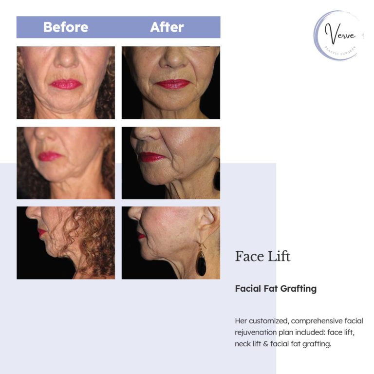Before and After images of Face Lift, Facial Fat Grafting - Her customized, comprehensive facial rejuvenation plan included: face lift, neck lift & facial fat grafting.
