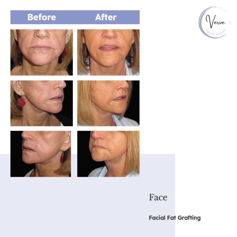 Before and After images of Face, Facial Fat Grafting