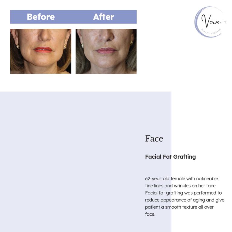 Before and After images of Face, Facial Fat Grafting - 62 year old female with noticeable fine lines and wrinkles on her face. Facial fat grafting was performed to reduce appearance of aging and give patient a smooth texture all over face.