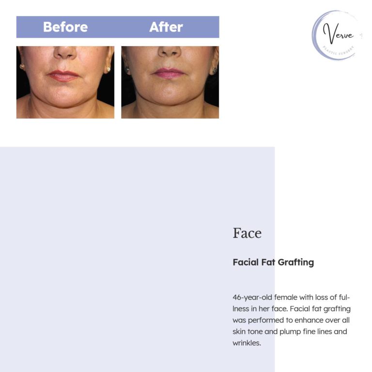 Before and After images of Face, Facial Fat Grafting - 46 year old female with loss of fullness in her face. Facial fat grafting was performed to enhance over all skin tone and plump fine lines and wrinkles.