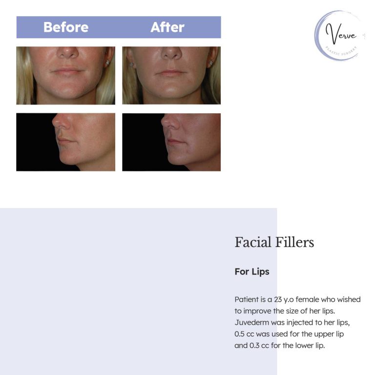 Before and After image of Facial Fillers For Lips - Patient is a 23 y.o female who wished to improve the size of her lips. Juvederm was injected to her lips, 0.5 cc was used for the upper lip and 0.3 cc for the lower lip.