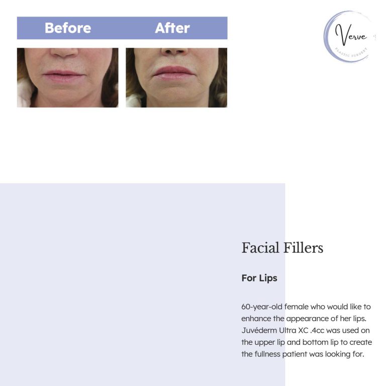 Before and After image of Facial Fillers For Lips - 60 year old female who would like to enhance the appearance of her lips. Juvederm Ultra XC .4cc was used on the upper lip and bottom lip to create the fullness patient was looking for.