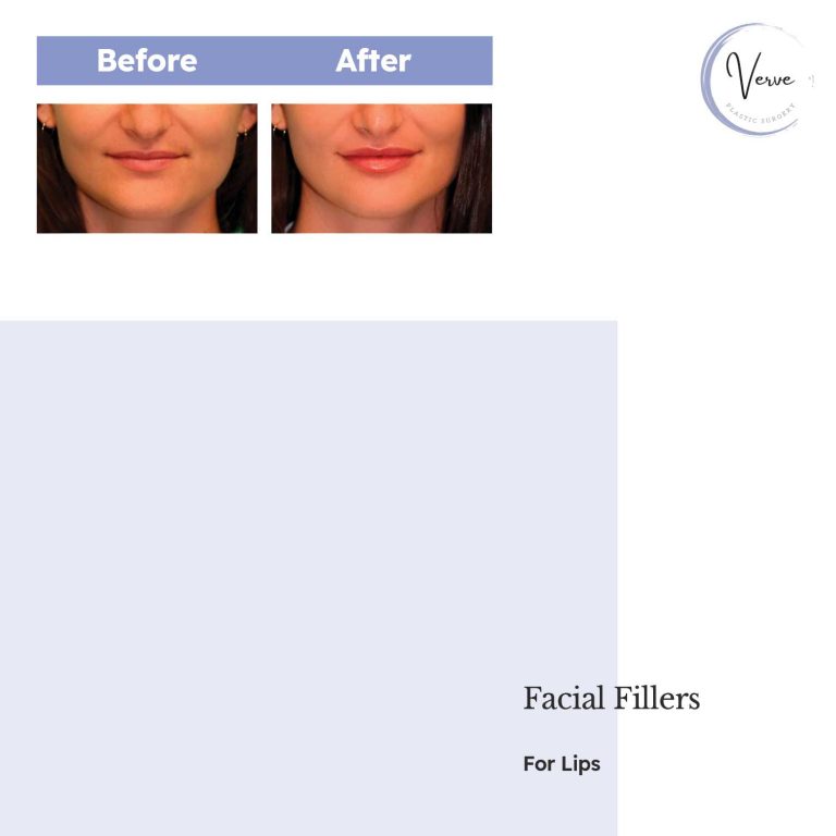 Before and After image of Facial Fillers For Lips