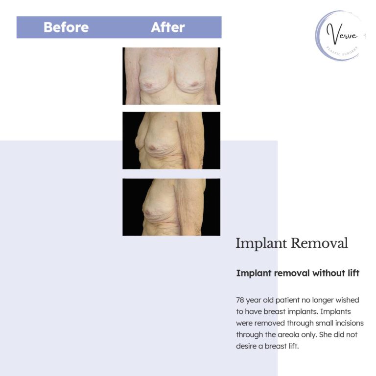 Before and After images of Implant Removal, Implant removal without lift - 78 year old patient no longer wished to have breast implants. Implants were removed through small incisions through the areola only. She did not desire a breast lift.