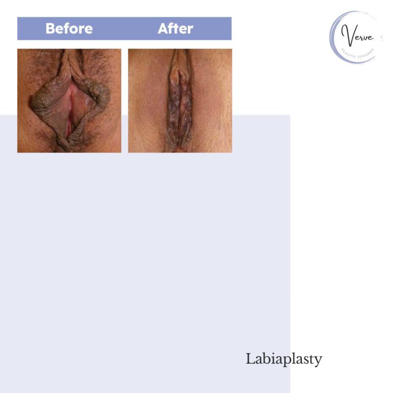 Before and After images of Labiaplasty