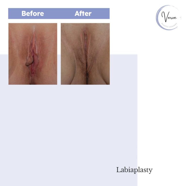 Before and After images of Labiaplasty