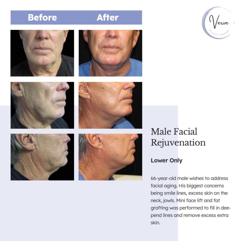 Before and After images of Male Facial Rejuvenation Lower Only - 66 year old male wishes to address facial aging. His biggest concerns being smile lines, excess skin on the neck, jowls. Mini face lift and fat grafting was performed to fill in deepened lines and remove excess extra skin.