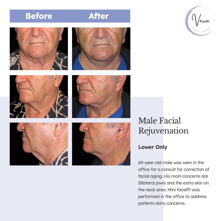 Before and After images of Male Facial Rejuvenation Lower Only - 69 year old male was seen in the office for a consult for correction of facial aging. His main concerns are Bilateral jowls and the extra skin on the neck area. Mini facelift was performed in the office to address patients skin concerns.