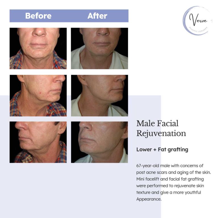 Before and After images of Male Facial Rejuvenation Lower + Fat Grafting - 67 year old male with concerns of post acne scars and aging of the skin. Mini facelift and facial fat grafting were performed to rejuvenate skin texture and give a more youthful appearance.
