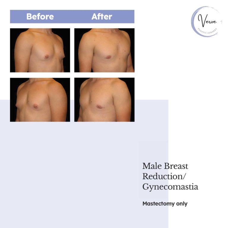 Before and After images of Male Breast Reduction/Gynecomastia Mastectomy only