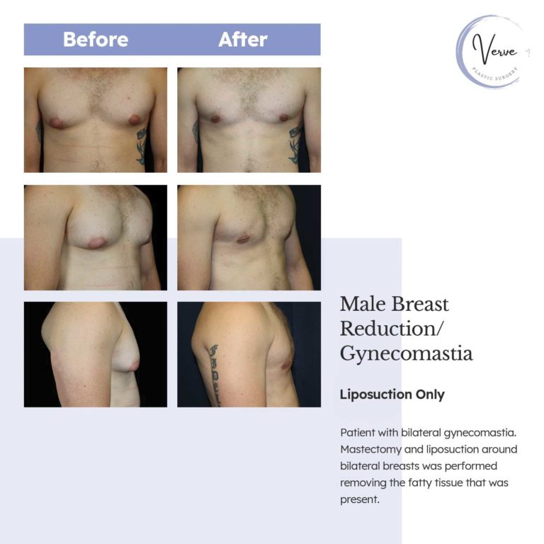 Before and After images of Male Breast Reduction/Gynecomastia Liposuction Only - Patient with bilateral gynecomastia. Mastectomy and liposuction around bilateral breasts was performed removing the fatty tissue that was present.