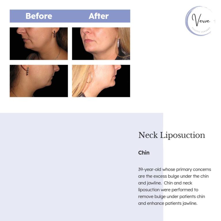 Before and After Images of Neck Liposuction, Chin - 39 year old whose primary concerns are the excess bulge under the chin and jawline. Chin and neck liposuction were performed to remove bulge under patients chin and enhance patients jawline.