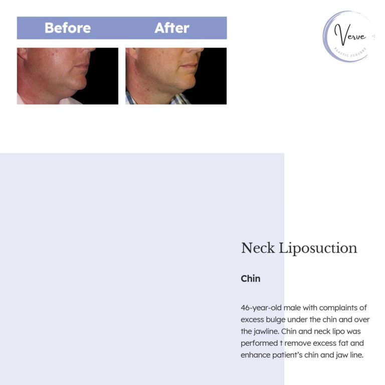 Before and After Images of Neck Liposuction, Chin - 46 year old male with complaints of excess bulge under the chin and over the jawline. Chin and neck lipo was performed to remove excess fat and enhance patient's chin and jaw line.