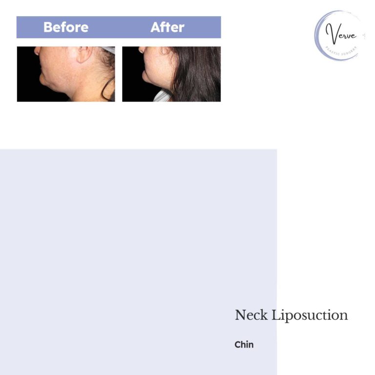 Before and After Images of Neck Liposuction, Chin