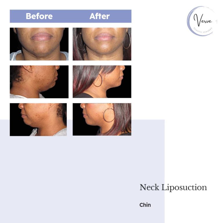 Before and After Images of Neck Liposuction, Chin