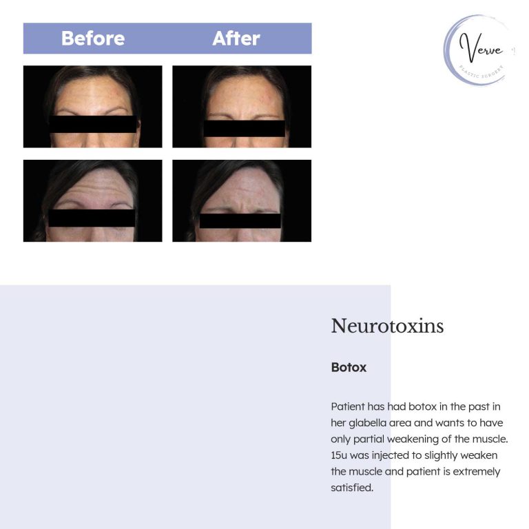 Before and After images of Neurotoxins Botox - Patient has had botox in the past in her glabella area and wants to have only partial weakening of the muscle. 15u was injected to slightly weaken the muscle and patient is extremely satisfied.