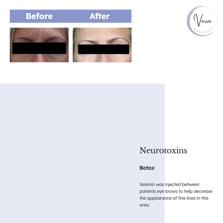 Before and After Image of Neurotoxins Botox - Xeomin was injected between patients eye brows to help decrease the appearance of fine lines in this area.