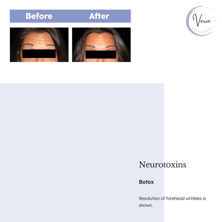 Before and After Image of Neurotoxins Botox - Resolution of forehead wrinkles is shown